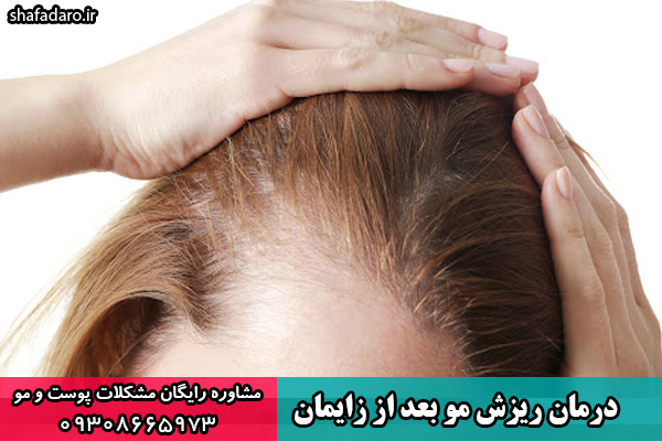 درمان ریزش مو بعد از زایمان