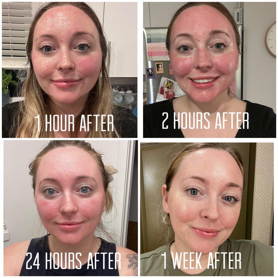 درمان لک بعد از لیزر صورت