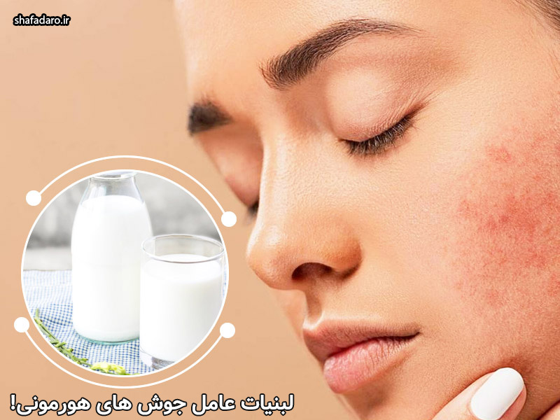 لبنیات و جوش صورت