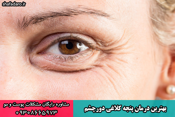 درمان پنجه کلاغی دور چشم