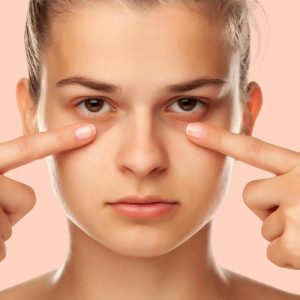 بهترین کرم دور چشم برای رفع تیرگی